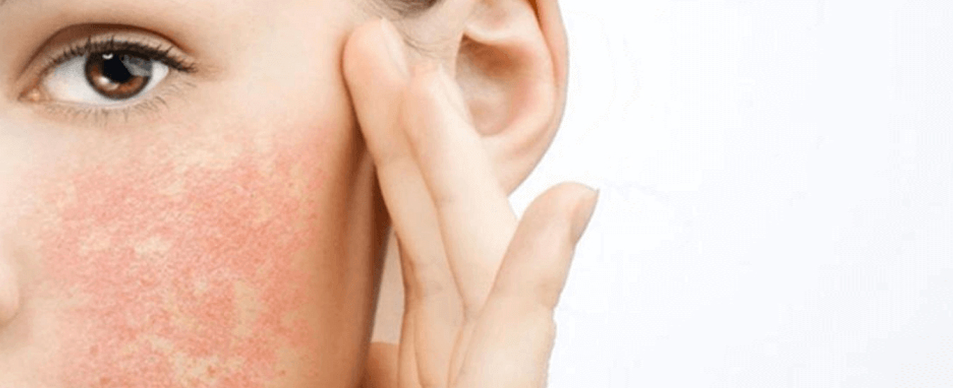 Аллергия может перерасти в псориаз