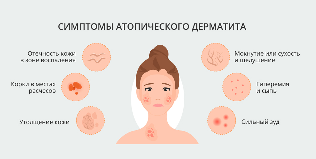 Атопический дерматит (нейродермит)