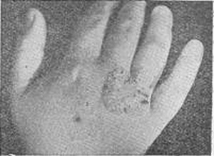 Eczema microbicum у 11-летнего мальчика