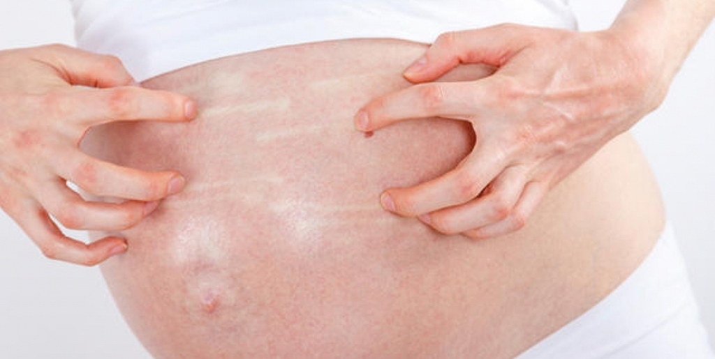 Как влияет псориаз на беременность