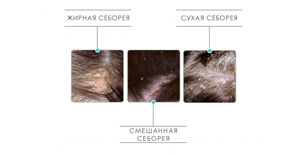 Чем себорейный псориаз отличается от дерматита - лечение в СПб