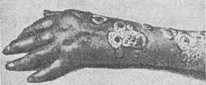 Псориаз монетовидный на запястьи, участками на предплечья, с псoриатической артропатией кисти и пальцев.