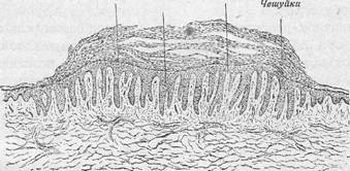 Гистология псориаза. Срез маленького старого пятна в области локтя. (Увеличение 50: 1)