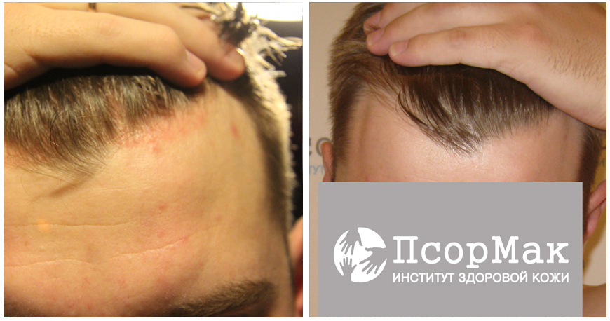 Результат лечения псориаза волосистой части головы, псориаза локтей. Пациент С.