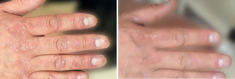 Лечение псориаза на ногтях