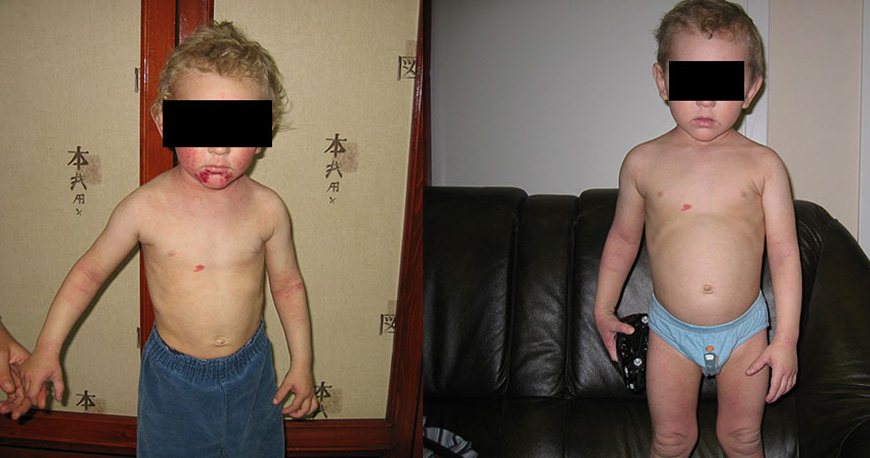 Результат лечения атопического дерматита. Пациент О., 3 года.