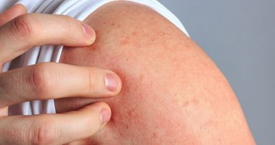 Основные виды дерматита: типичные проявления и опасность для окружающих