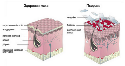 Что такое псориаз