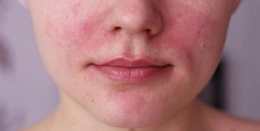 Лечение атопического дерматита на лице с ремиссией до 6 лет
