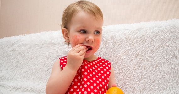 Как лечить диатез у месячного ребенка