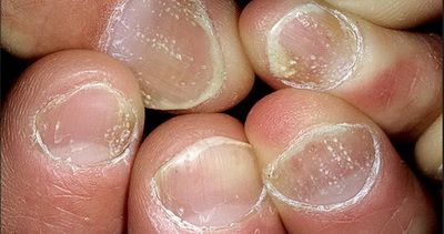 Лечение псориаза ногтей