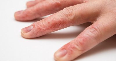 Лечение экземы на пальцах рук