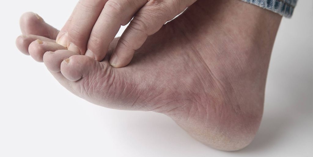 Лечение дисгидротической экземы стоп ног