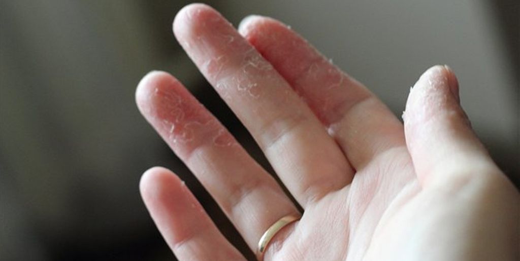 Лечение псориаза кожи рук в Москве